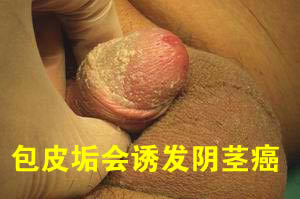 男人为什么一定要割包皮,西宁最好的男科医院——西宁青院中西医结合医院