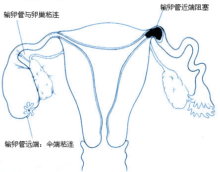 输卵管为什么会发炎