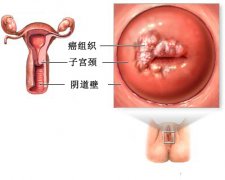 是什么引起的宫颈出血